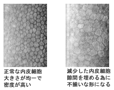 角膜内皮細胞比較