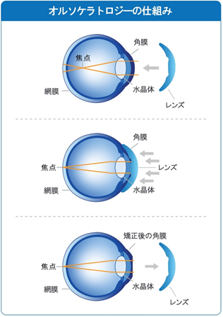 オルソケラトロジー仕組み