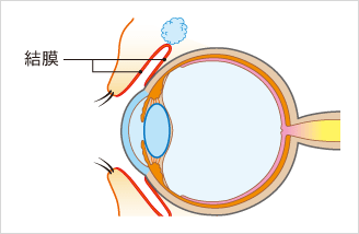 結膜炎について
