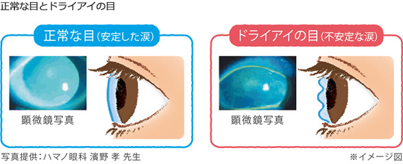 ドライアイとは