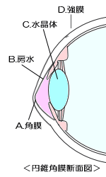 円錐角膜断面図