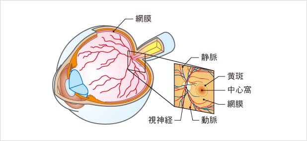 加齢黄斑変性とは