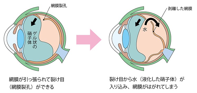 網膜剥離とは