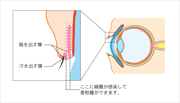 ものもらいとは